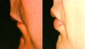 Example of Lip Enhancement using Aquamid