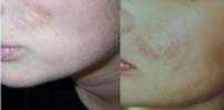 Example of Aquamid's suitability for Scar reduction/removal