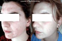 Before & After Example of SkinTech Acne Treatment