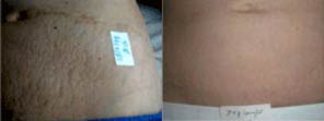 Before & After Example of SkinTech Treatment for Stretchmarks